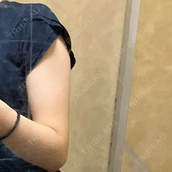 脂肪吸引（二の腕） アムルーズ美容外科クリニック 横浜院 BEFORE メイン用