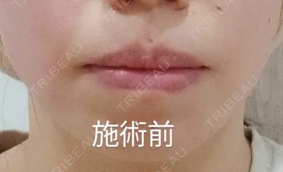 ヒアルロン酸注入（唇） Tokyo Tensei Clinic 新宿院 BEFORE メイン用