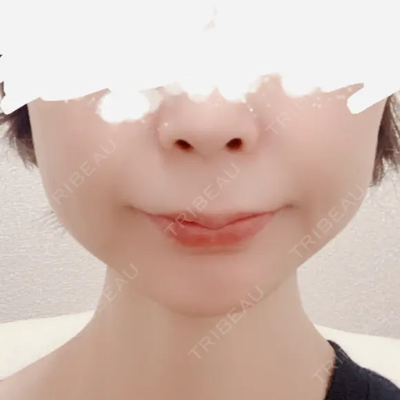 ボトックス（エラ・小顔） 共立美容外科 梅田院 BEFORE メイン用