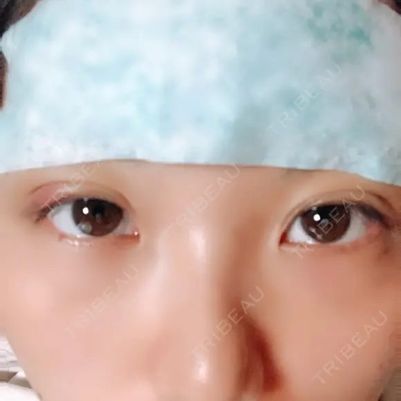 二重埋没 湘南美容クリニック 鹿児島院 BEFORE メイン用