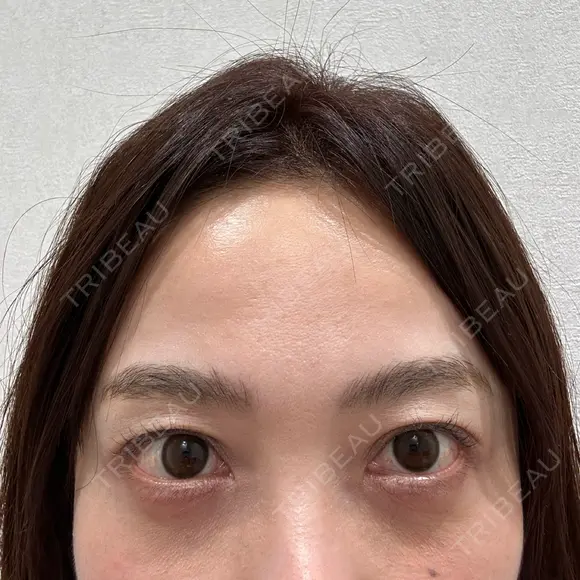 クマ治療 / スネコス PRISM Beauty Clinic 町田院 BEFORE メイン用