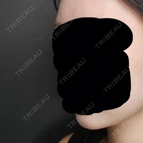 ヒアルロン酸注入（あご） Tokyo Tensei Clinic 新宿院 BEFORE メイン用