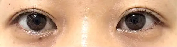 目尻切開 / タレ目形成・グラマラスライン（埋没） A CLINIC（エークリニック） 新宿院 BEFORE メイン用