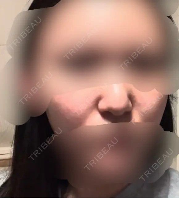 脂肪溶解注射（顔） / ヒアルロン酸注入（鼻翼基部） SK新宿歌舞伎町美容外科・歯科 BEFORE メイン用