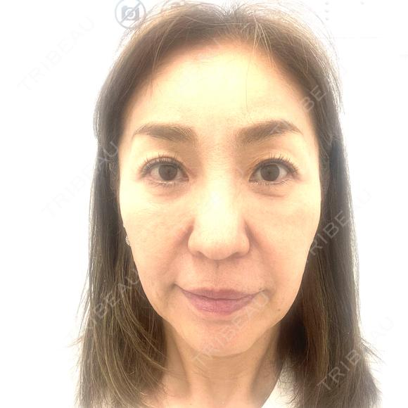 ボトックス（あご） / ボトックス（口角） / ボトックス（眉間） / ボトックス（額） TCB東京中央美容外科 自由が丘院 BEFORE メイン用