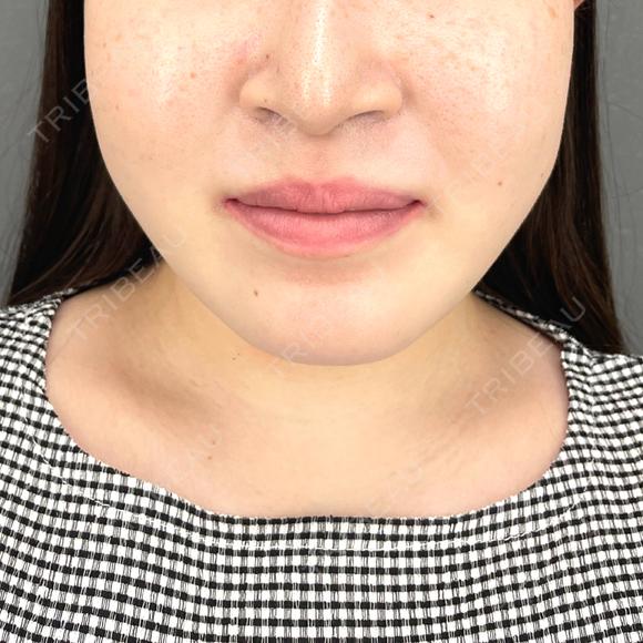 ヒアルロン酸注入（鼻翼基部） ziz CLINIC BEFORE メイン用