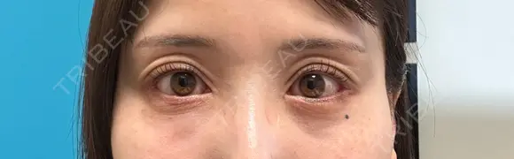 タレ目形成・グラマラスライン（切開） アネシス美容クリニック BEFORE メイン用