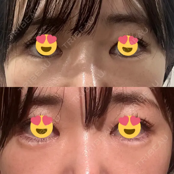 ヒアルロン酸注入（涙袋） / ヒアルロン酸注入（唇） / ボトックス（人中） HAAB×DREAM BEAUTY CLINIC 東京本院 BEFORE メイン用