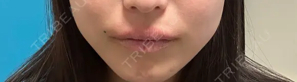 その他（口元） アネシス美容クリニック BEFORE メイン用