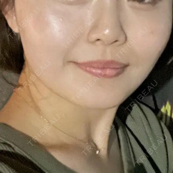 糸リフト / 脂肪吸引（顔） / ヒアルロン酸注入（唇） 仙台TAクリニック BEFORE メイン用