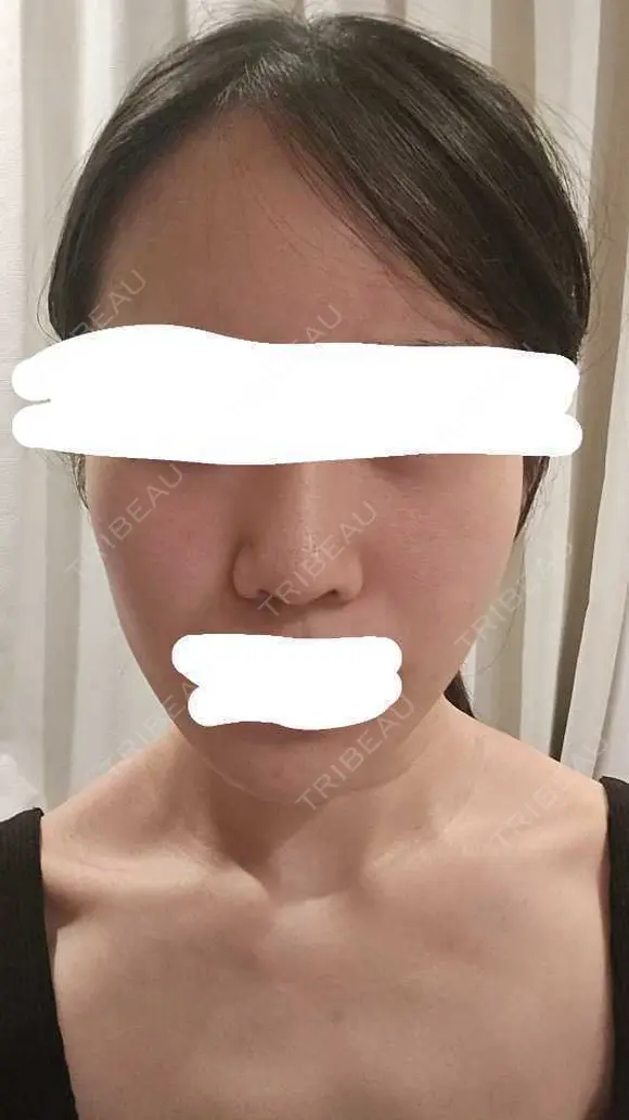 水光注射（ハリ・美肌） RAISE CLINIC 【レイズクリニック】 BEFORE メイン用