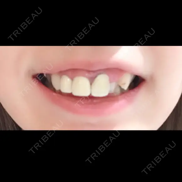 その他（審美歯科/矯正歯科） / セラミック 東京美容外科 赤坂院 BEFORE メイン用