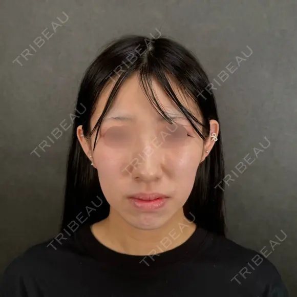 二重埋没 / 目頭切開 / 糸リフト / 脂肪吸引（顔） / ヒアルロン酸注入（涙袋） / ヒアルロン酸注入（あご） / ボトックス（エラ・小顔） / ボトックス（人中） ネビュラクリニック 京都院 BEFORE メイン用