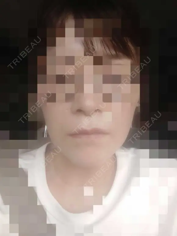 ボトックス（エラ・小顔） PRISM Beauty Clinic 町田院 BEFORE メイン用
