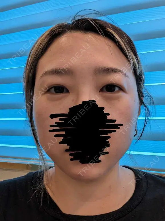 上まぶたたるみ取り / ダーマペン / 毛穴洗浄（ハイドラフェイシャルなど） Leap beauty clinic BEFORE メイン用