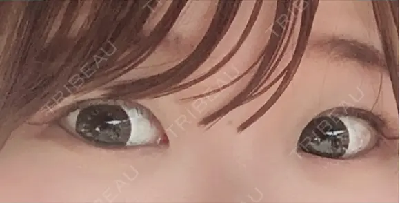 二重埋没 新宿麗美容皮膚科	 BEFORE メイン用