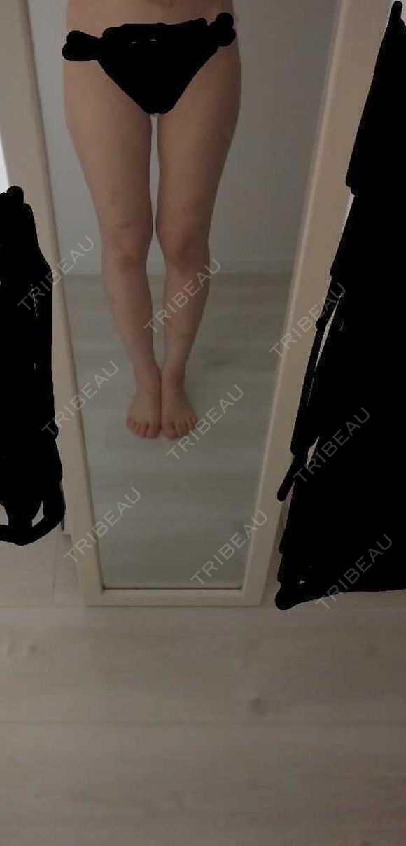脂肪吸引（脚） 共立美容外科 仙台院 BEFORE メイン用