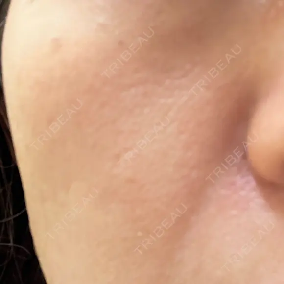 フラクショナルレーザー（毛穴・ニキビ跡） ガーデンクリニック 名古屋院 BEFORE メイン用