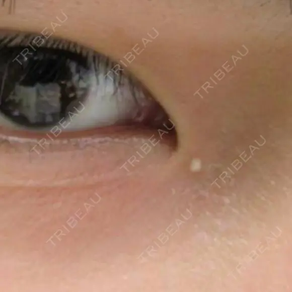 ほくろ・いぼ切除（肌） ガーデンクリニック 船橋院 BEFORE メイン用