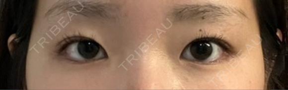 目頭切開 / 自然癒着法 / 眼瞼下垂（非切開） LUHO（ルホ）美容外科 BEFORE メイン用