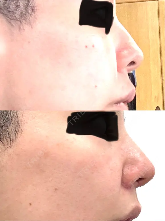 小鼻縮小（切開） / 鼻尖縮小 / 鼻柱下降・鼻唇角形成（猫手術） 東京シンデレラ美容外科 池袋院 BEFORE メイン用