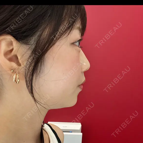 ヒアルロン酸注入（あご） ヴェリテクリニック 大阪院 BEFORE メイン用