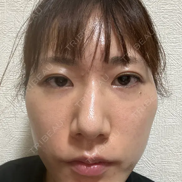 ボトックス（エラ・小顔） TCB東京中央美容外科 川口院 BEFORE メイン用