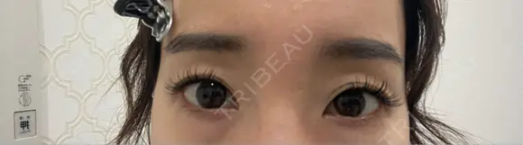 二重埋没 / ヒアルロン酸注入（目の下） BELINDA CLINIC（ベリンダクリニック）岡山院 BEFORE メイン用