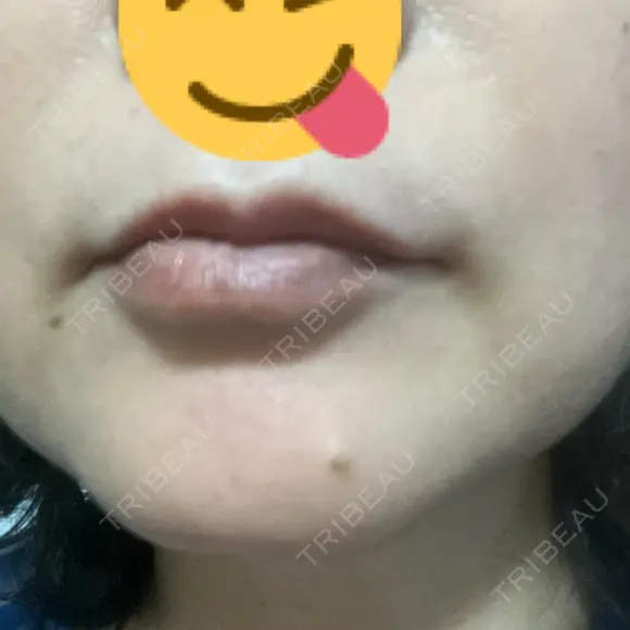 医療脱毛（顔） 美容皮膚科エルムクリニック 大阪院 BEFORE メイン用