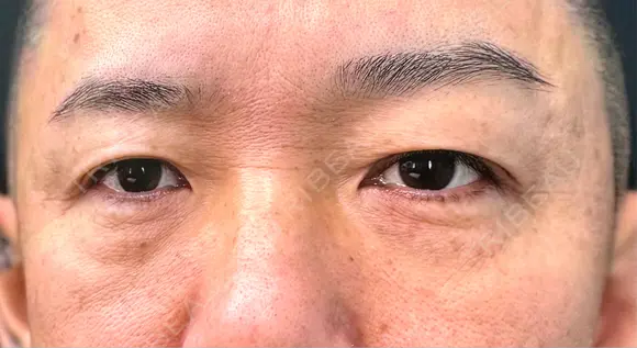下まぶたたるみ取り / 下まぶたの脂肪取り / 脂肪注入（目の下） 湘南美容クリニック 千葉センシティ院 BEFORE メイン用