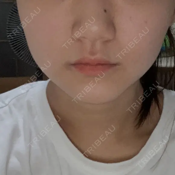 糸リフト / 脂肪吸引（顔） / ボトックス（エラ・小顔） ルラ美容クリニック 広島院 BEFORE メイン用