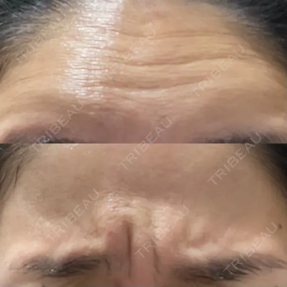 ボトックス（眉間） / ボトックス（額） / その他（鼻） ROOTS Clinic BEFORE メイン用