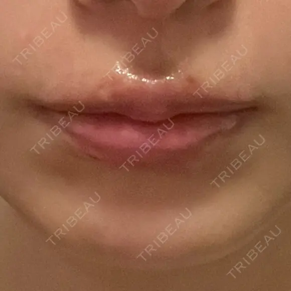 ヒアルロン酸注入（涙袋） / ヒアルロン酸注入（唇） フィラークリニック 渋谷院 BEFORE メイン用