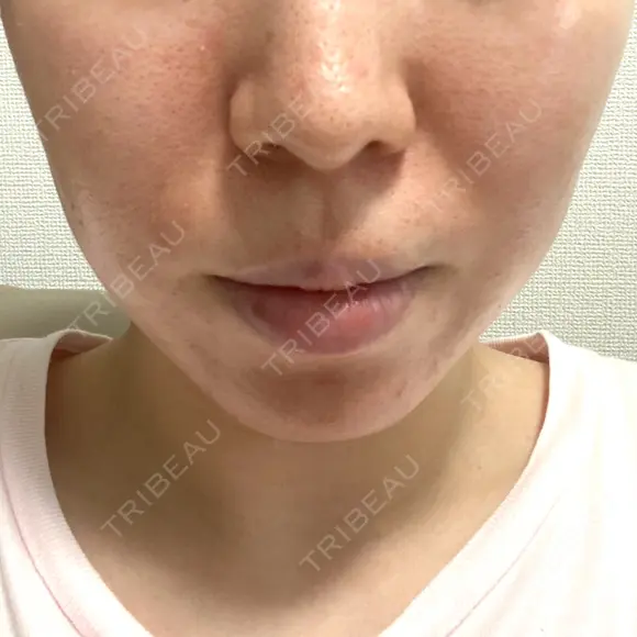 糸リフト / 脂肪吸引（顔） EMMA CLINIC（エマクリニック） BEFORE メイン用