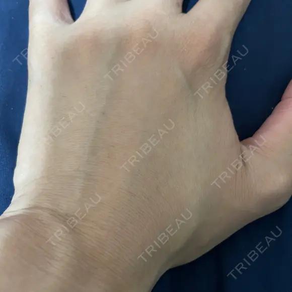 脂肪注入（肌） EMMO FACE CLINIC 大阪梅田院 BEFORE メイン用