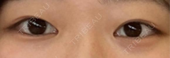 二重埋没 / 上まぶたの脂肪取り アリエル美容クリニック 郡山院 BEFORE メイン用