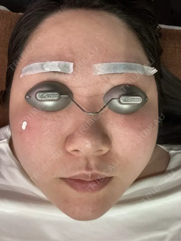 ピコレーザートーニング（美白・肝斑） / ピコフラクショナルレーザー（毛穴・ニキビ跡） おおかみ美容のクリニック 新宿院 BEFORE メイン用