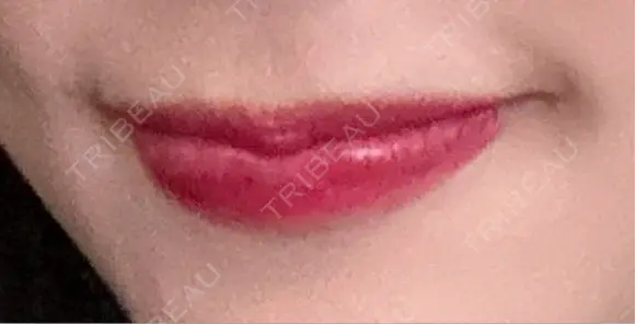 ヒアルロン酸注入（唇） REAL BEAUTY CLINIC 新宿東口院 BEFORE メイン用