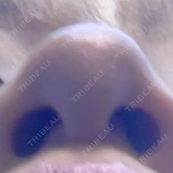 隆鼻術 / ヒアルロン酸注入（鼻） 渋谷美容外科クリニック 新宿院 BEFORE メイン用