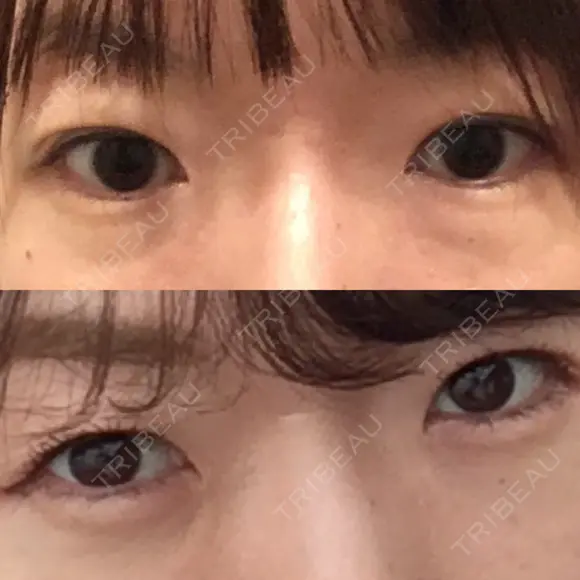 二重切開 / 上まぶたの脂肪取り 樹のひかり 形成外科・皮ふ科 BEFORE メイン用