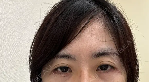 二重切開 / 傷跡修正 / 肌ヒアルロン酸注入（たるみ・シワ改善） / 美肌レーザー / シミ取りレーザー 石倉クリニック 水戸院 BEFORE メイン用