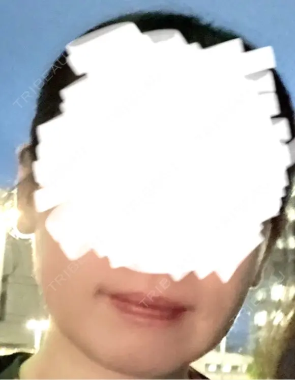 脂肪溶解注射（顔） TCB東京中央美容外科 青森院 BEFORE メイン用