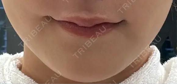 ボトックス（エラ・小顔） ルラ美容クリニック銀座院 BEFORE メイン用