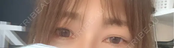 二重埋没 / 自然癒着法 東京シンデレラ美容外科 池袋院 BEFORE メイン用