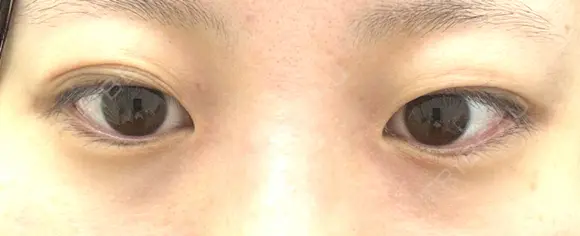 二重埋没 シンデレラ＆ダヴィンチクリニック BEFORE メイン用