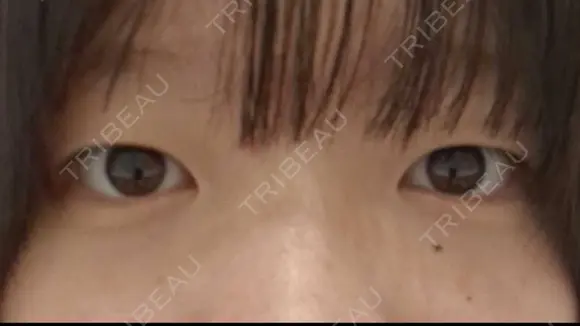 二重埋没 ルラ美容クリニック 渋谷本院 BEFORE メイン用