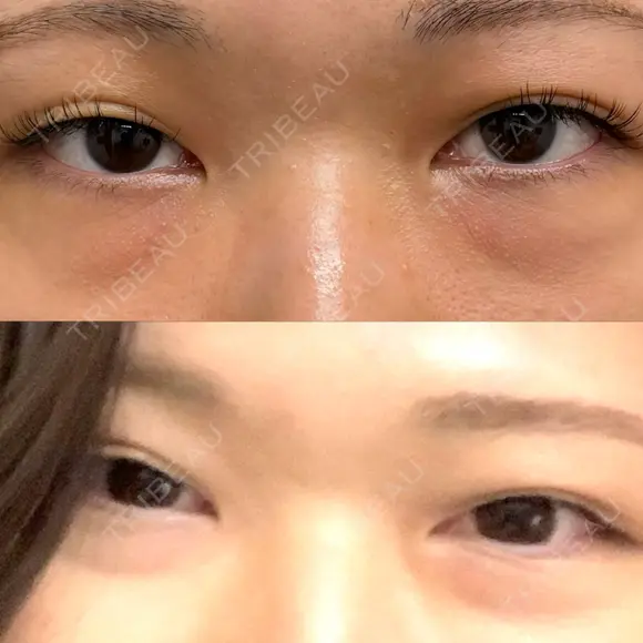 クマ治療 / ボトックス（あご） / ヒアルロン酸注入（あご） ネビュラクリニック 京都院 BEFORE メイン用