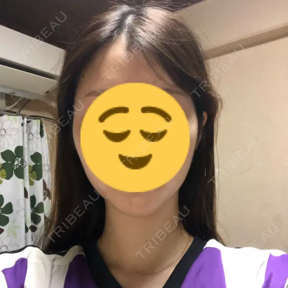 ボトックス（エラ・小顔） 共立美容外科 京都院 BEFORE メイン用