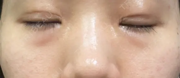 クマ治療 TCB東京中央美容外科 熊本院 BEFORE メイン用