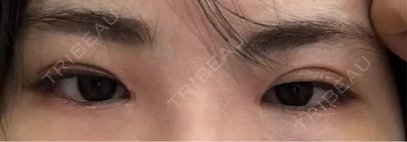 二重切開 / 眼瞼下垂（切開） オーキッド美容クリニック東京御徒町 BEFORE メイン用